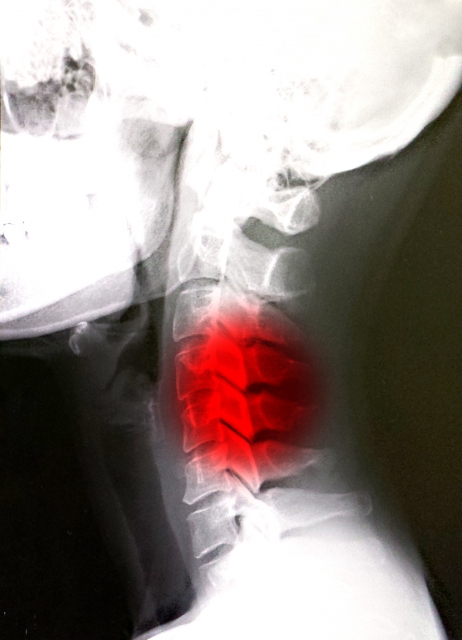 首の痛み　病院　頸椎ヘルニア