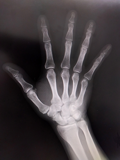 手首の腫れ　治療　さいたま市　病院