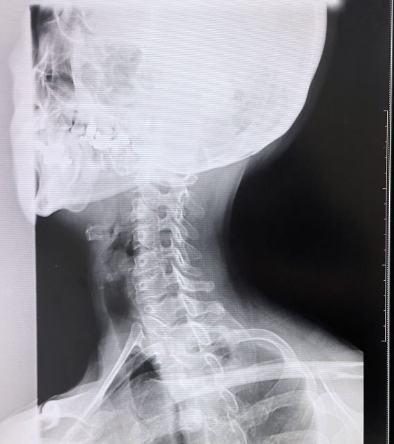むち打ち治療　おすすめの接骨院