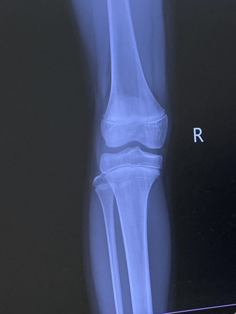 さいたま市　変形性膝関節症　病院　治療