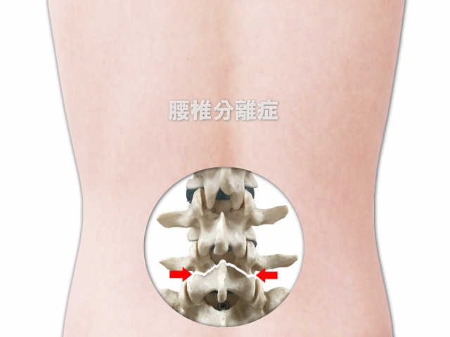 さいたま市　腰椎分離症　治療