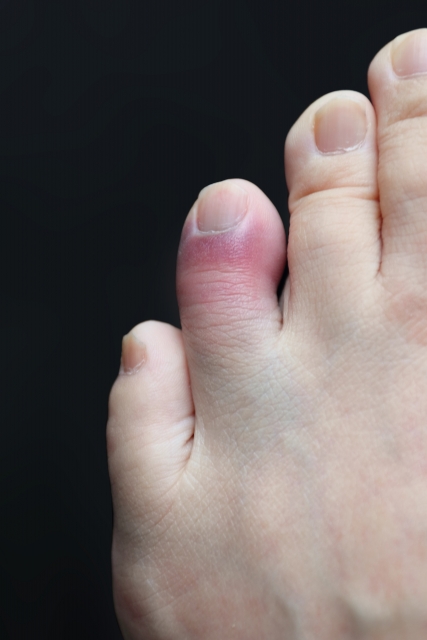 足の指をぶつけた　治療　接骨院